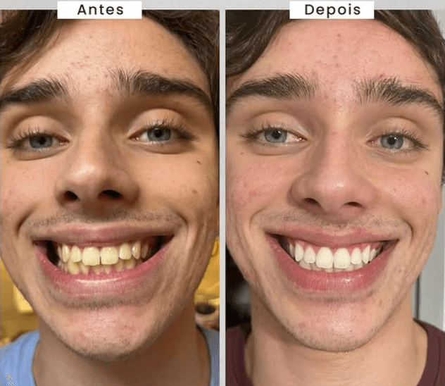 Caso de Clareamento Dental