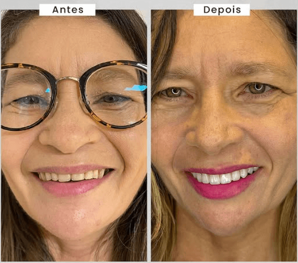 Caso de Implantes Dentários