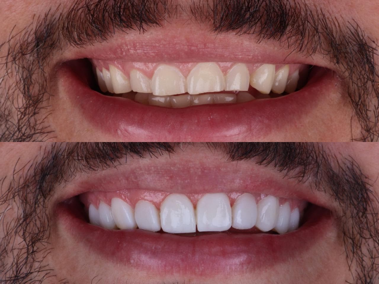 Caso de Lentes de Contato